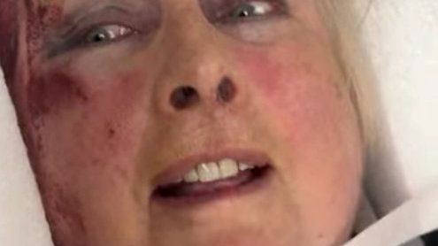 Binky Felstead's mum shares alarming video strapped to hospital bed with blood down her face — News news on dripviewz