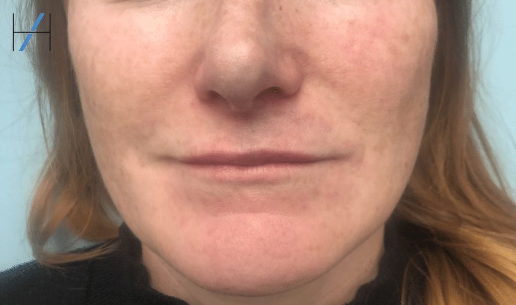 Lip Filler Vascular Occlusion Case Study Harley Academy