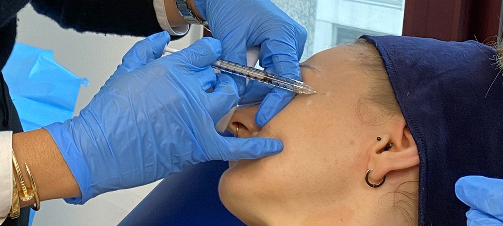 how-to-prevent-bruising-from-botox-harley-academy