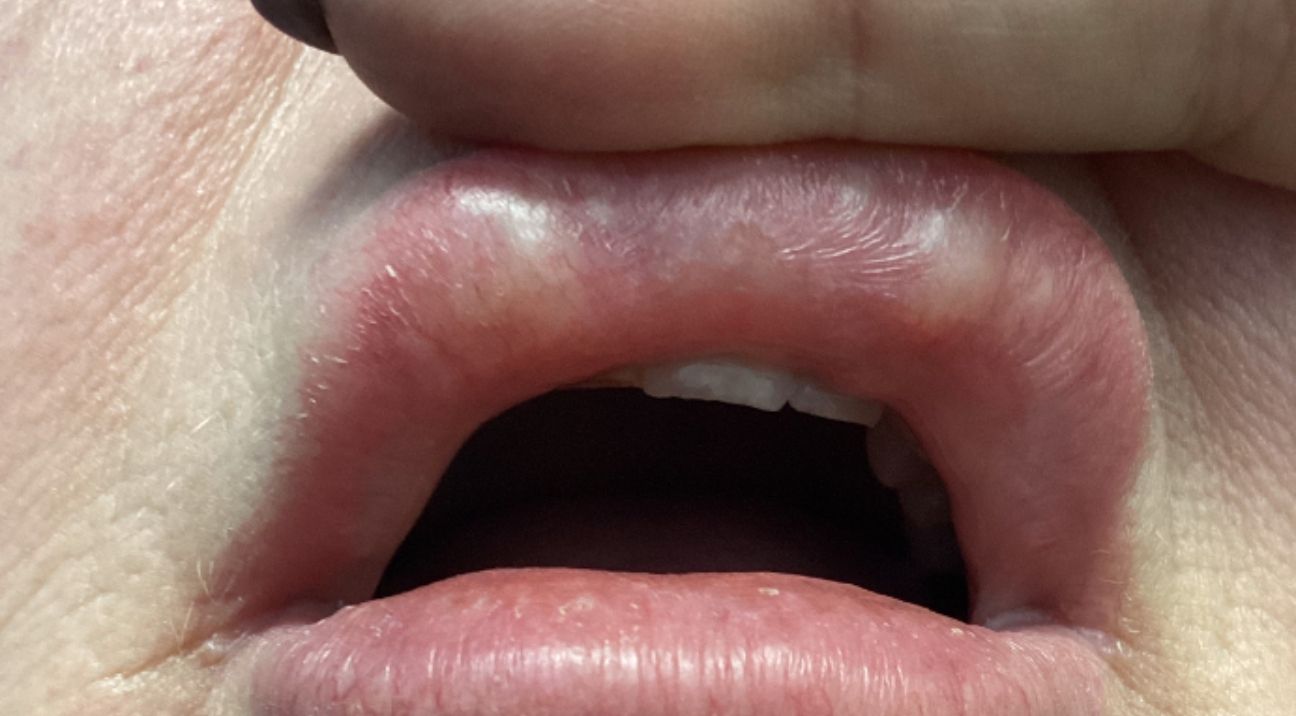 An Injectors' Guide to FillerRelated Nodules