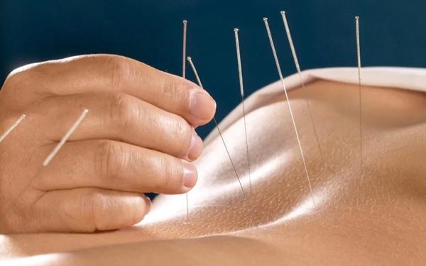 My Experience of Getting Acupuncture in Bangkok