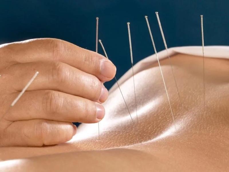 My Experience of Getting Acupuncture in Bangkok