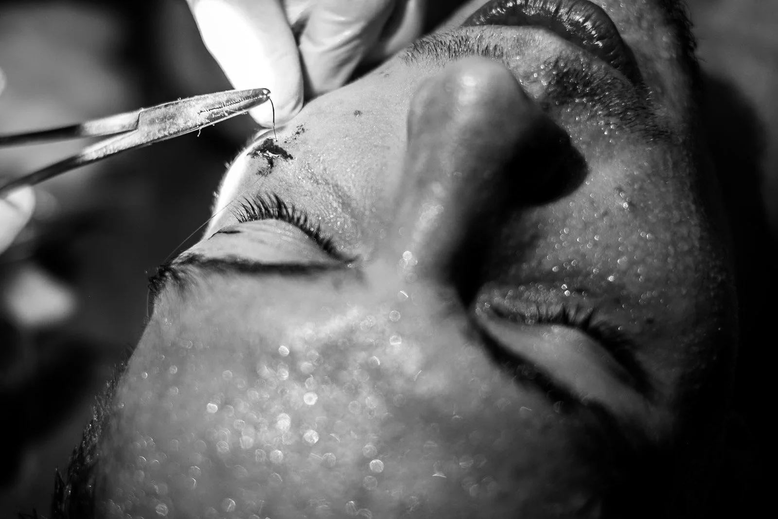 Doctor treats a cut above a Muay Thai fighter's eye