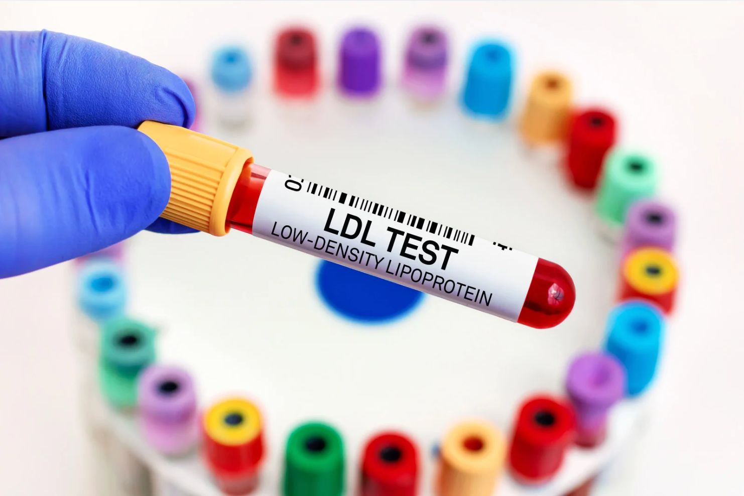Mit kell tudni az LDL koleszterinről? - Tájékoztató