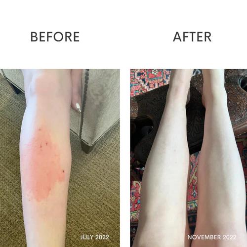 before and after image of Bergen's legs