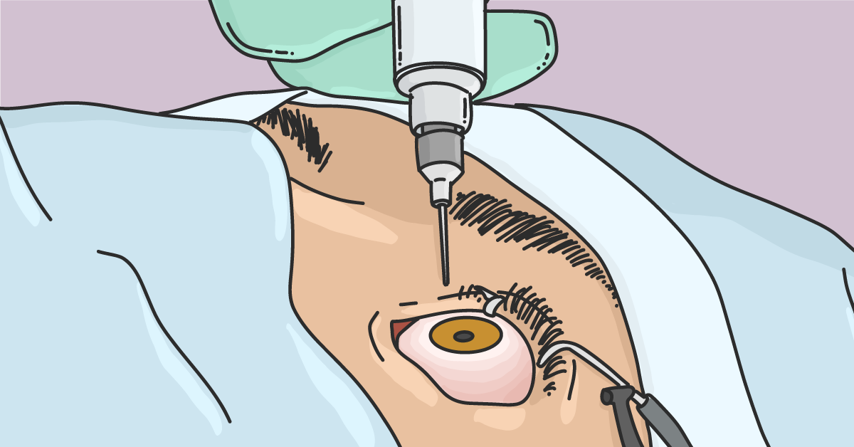 Robot system for wet AMD may lead to fewer injection treatments