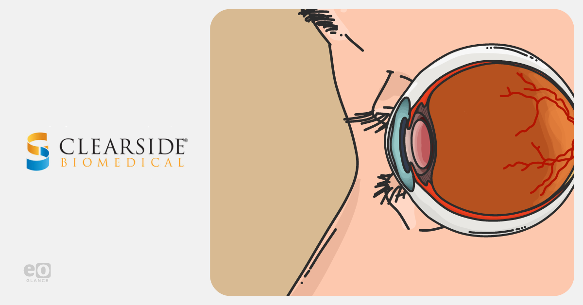 Clearside Biomedical reports phase 3 plans for SCS wet AMD therapy