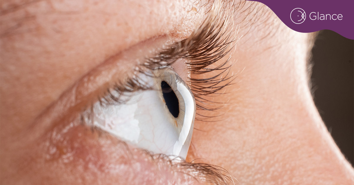 Keratoconus may be more prevalent than previously thought