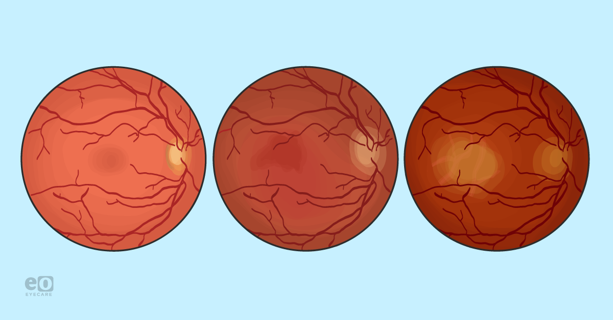 What Macular Degeneration to Geographic Atrophy Progression Really ...