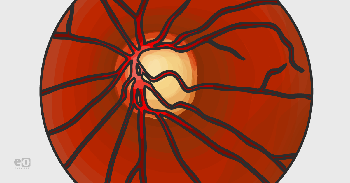 SteroidInduced Treatment, and Management