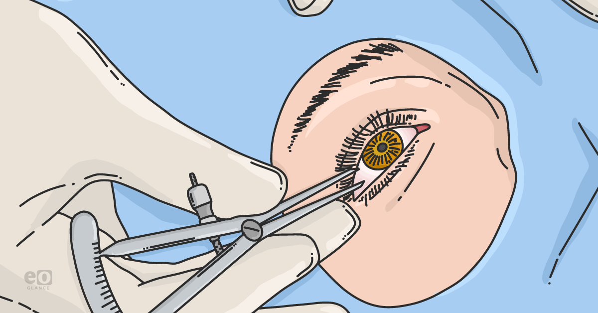 Ppv Optometry Earlier PPV may benefit vitrectomy among PDR patients