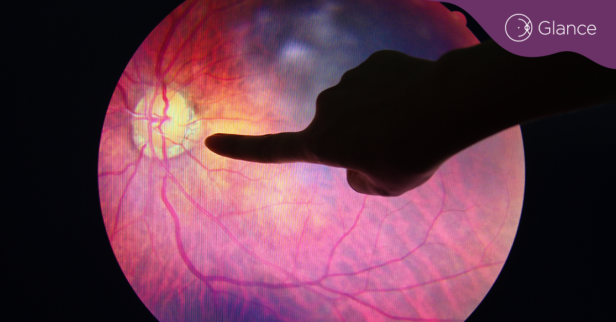 'Sugar hypothesis' of diabetic cataracts may be a myth