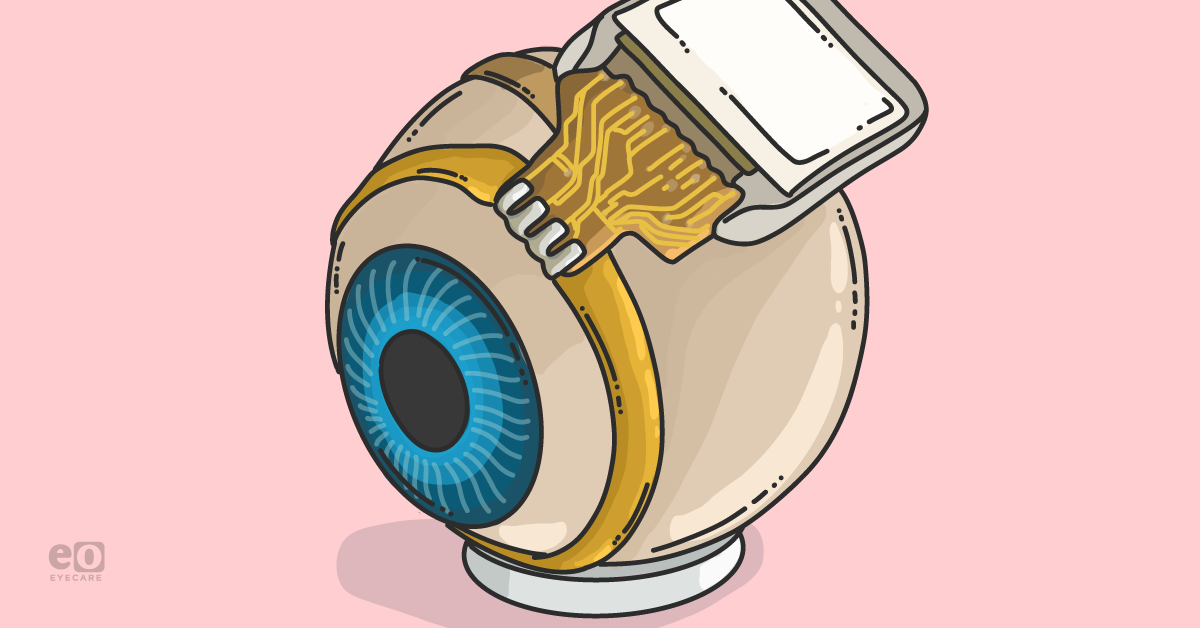 Focus on the Future: Bionic Implants for Ocular Diseases