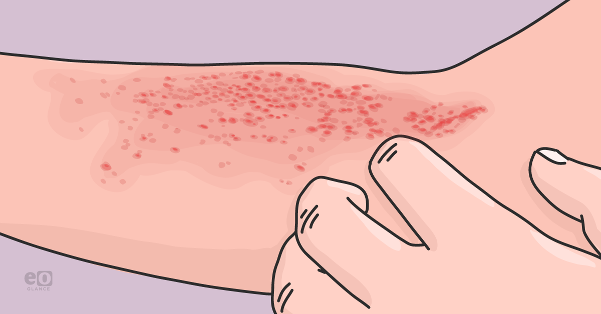 Ocular History Linked to Higher Risk of Recurrent Shingles