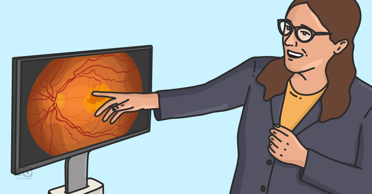 How to Identify Geographic Atrophy Early with Multimodal Imaging