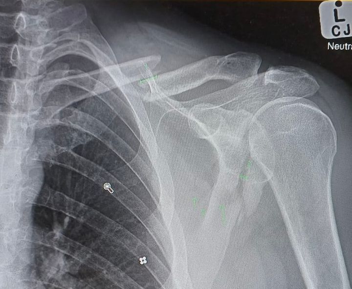 X-Ray of Donavan Roscoe's shattered shoulder