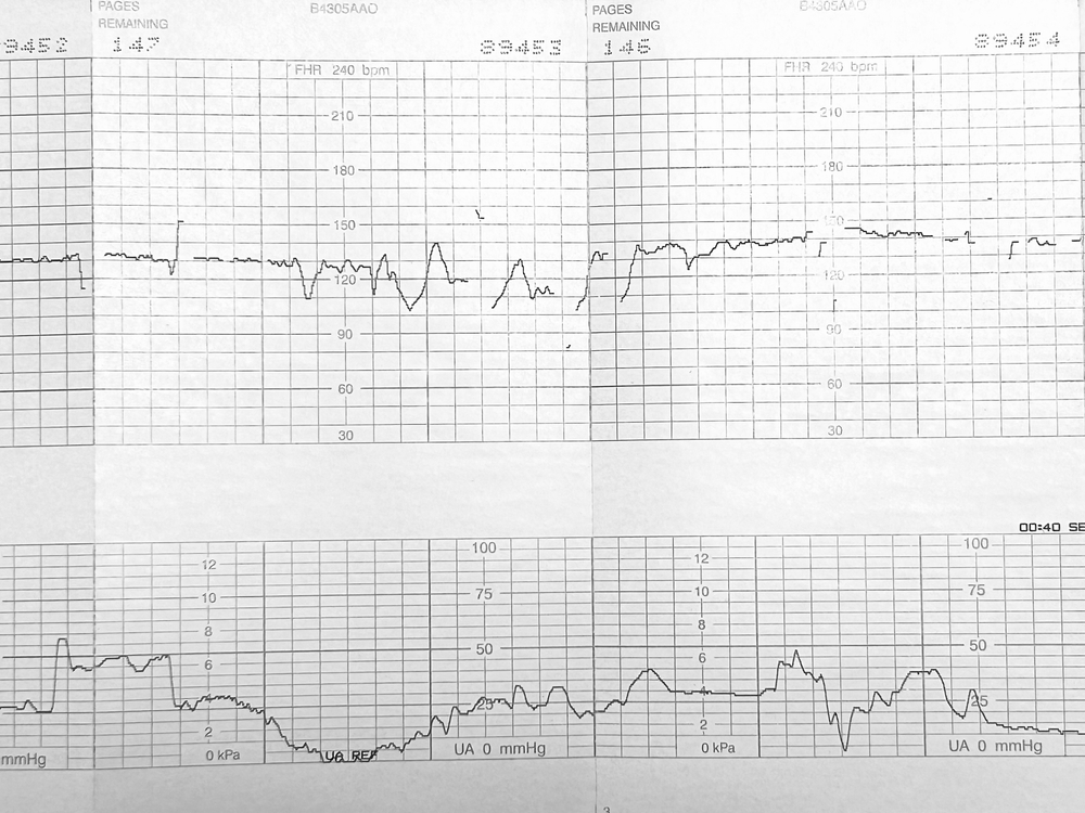 Image A medical printout of a fetal heart rate monitoring strip showing FHR and uterine activity, used to identify missed fetal monitoring red flags.