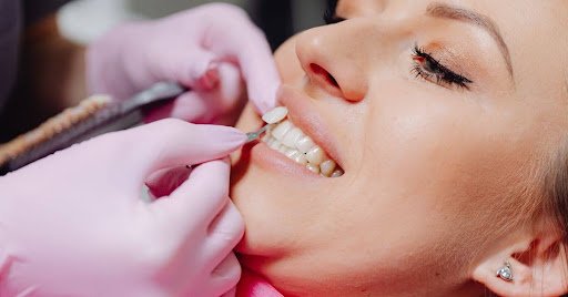 Veneers: Nutzen, Eingriff und Kosten realistisch abwägen