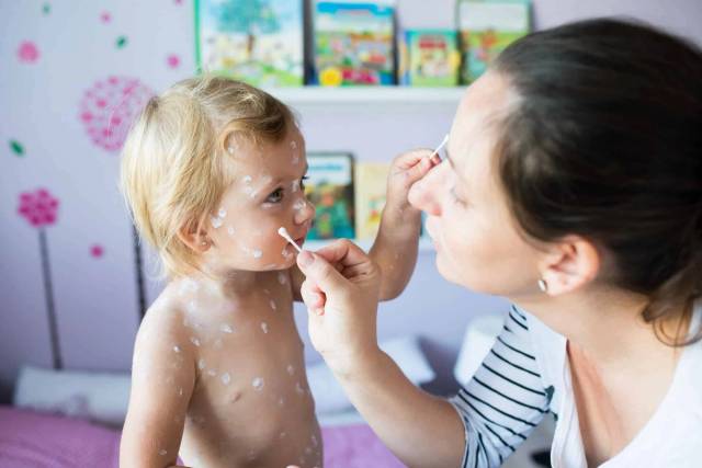 Consultation médicale pour le traitement de la varicelle chez l'enfant et l'adulte