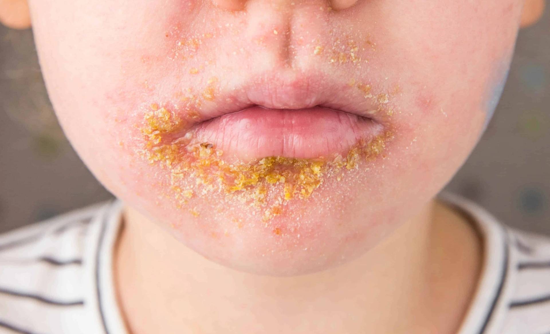 Gros plan de croûtes jaunâtres autour de la bouche d’un enfant.