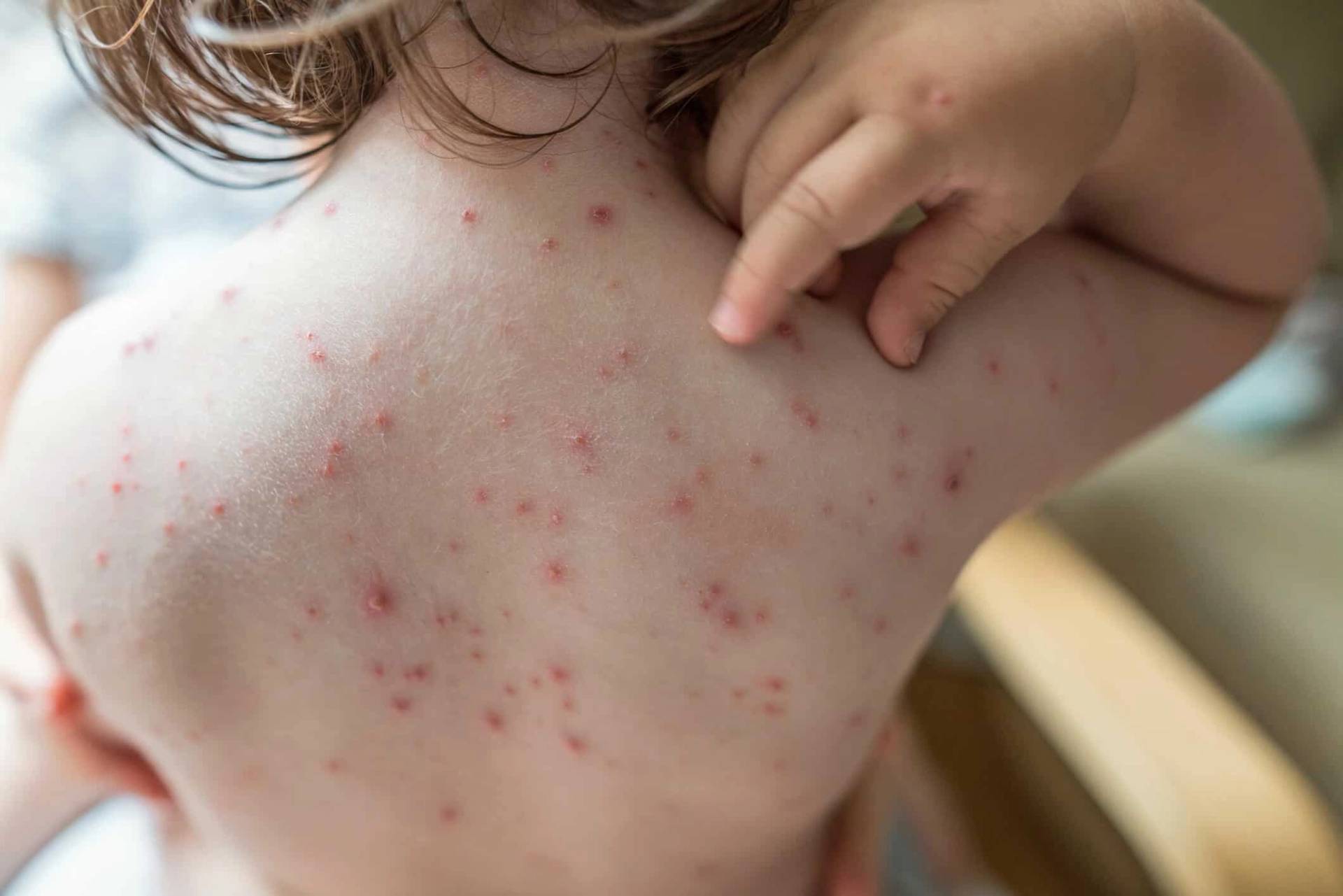 Examen médical d'un bouton de varicelle sur la peau d'un patient pendant une consultation