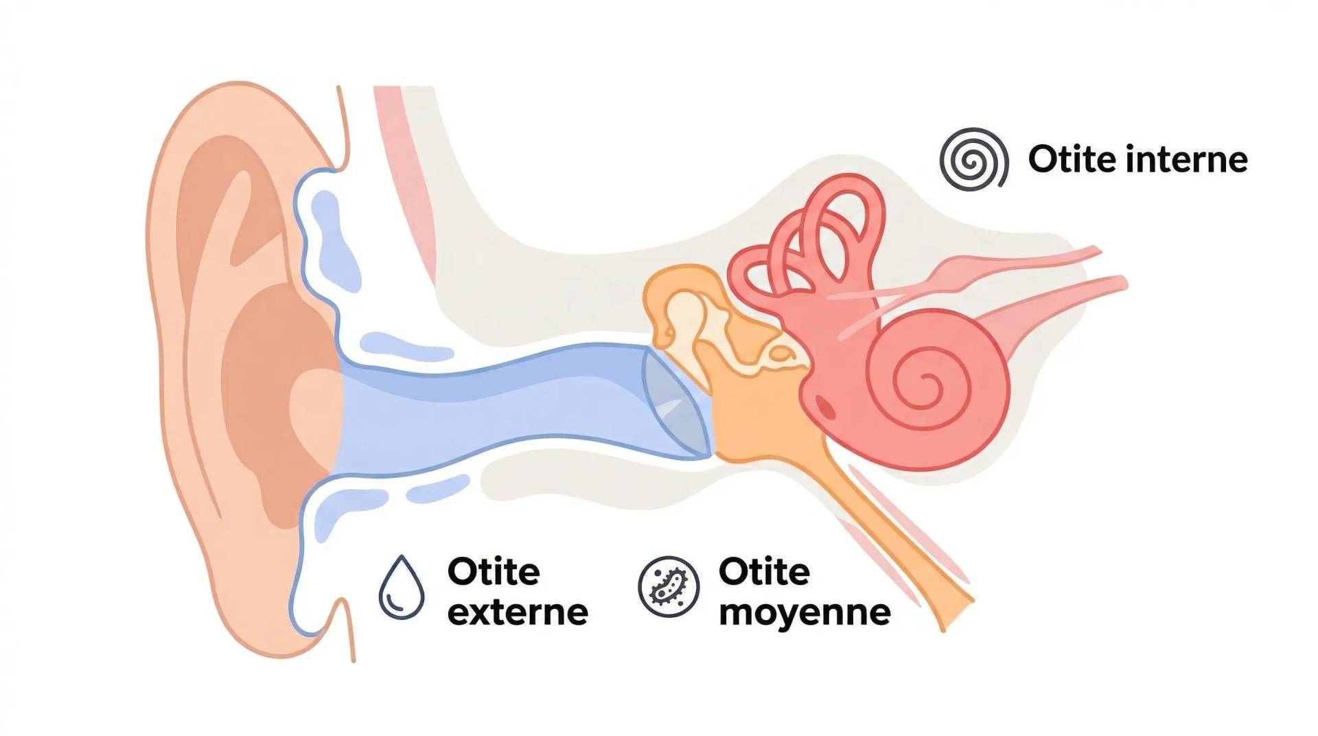 Schéma en coupe de l’oreille indiquant les zones des otites externe, moyenne et interne.