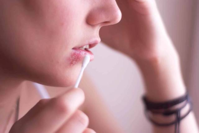 Médecin examinant un patient atteint d'herpès du visage lors d'une consultation médicale
