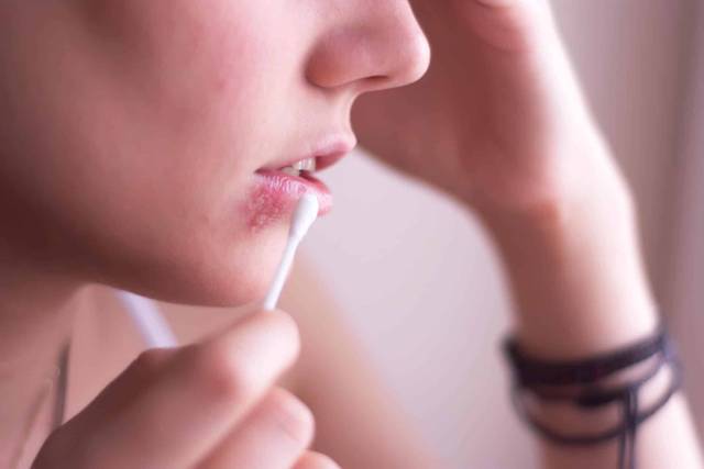 Médecin examinant un patient atteint d'herpès du visage lors d'une consultation médicale