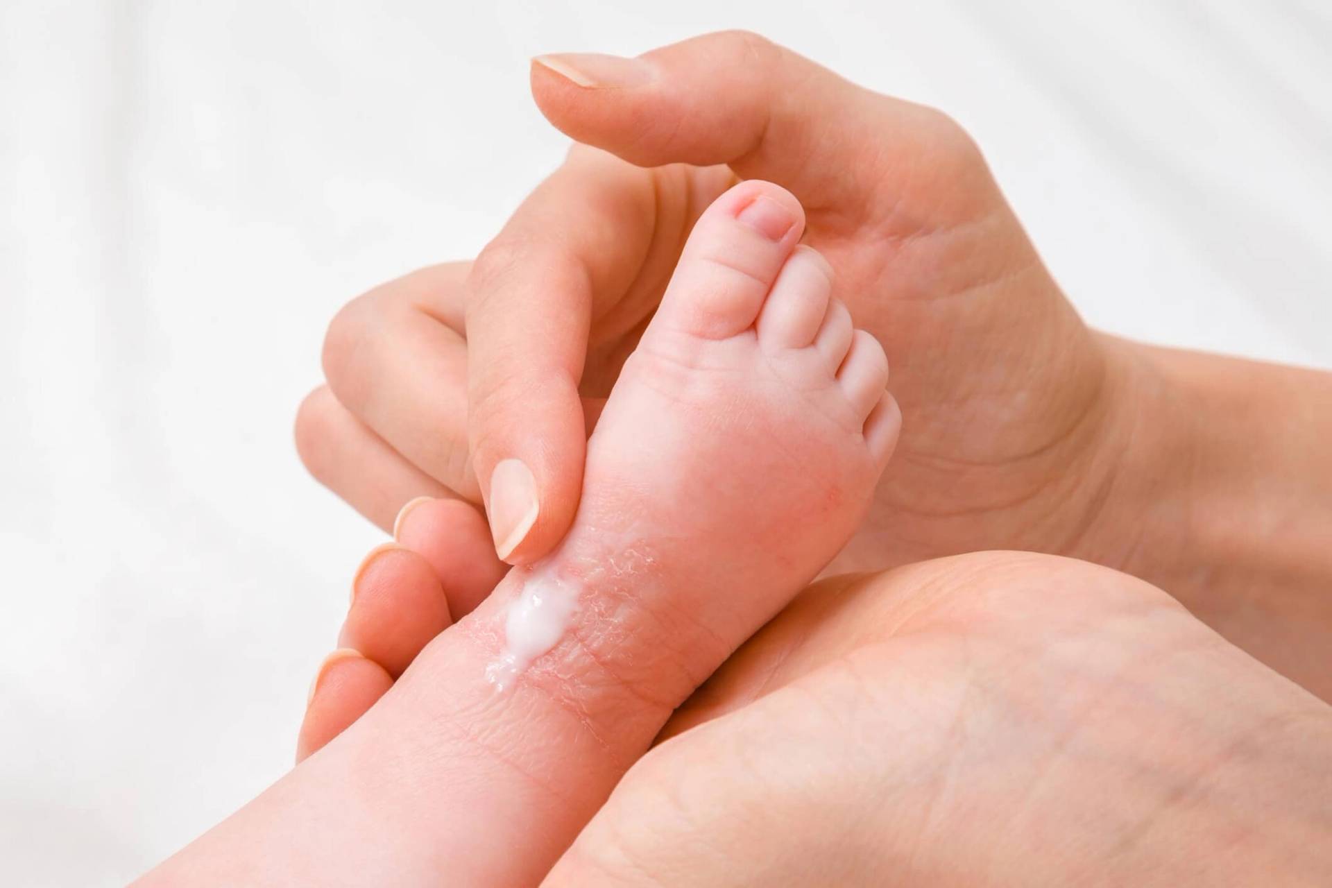 cause eczéma bébé