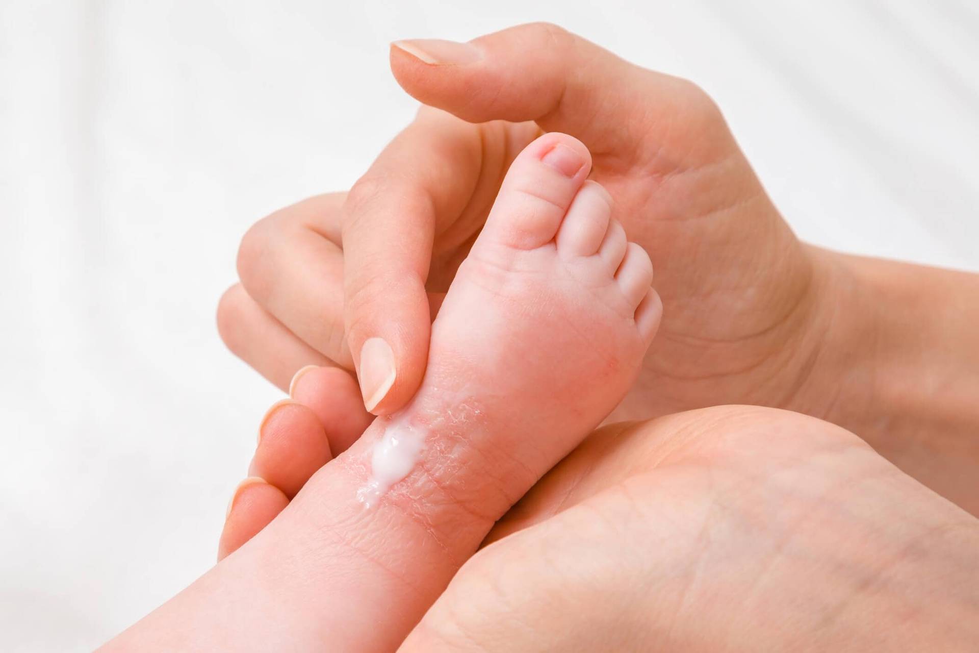 cause eczéma bébé