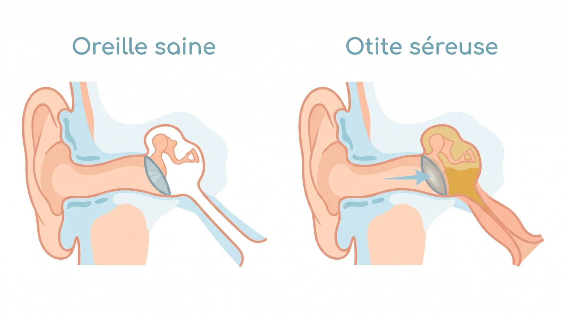 Schéma comparatif d'une oreille saine et d'une oreille atteinte d'otite séreuse avec accumulation de liquide derrière le