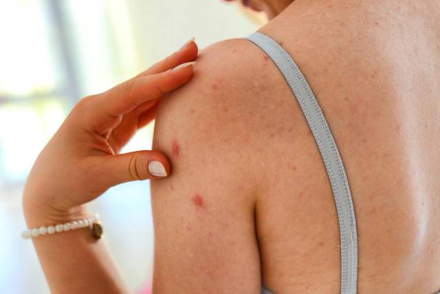 Consultation médicale pour varicelle adulte : médecin examinant un patient