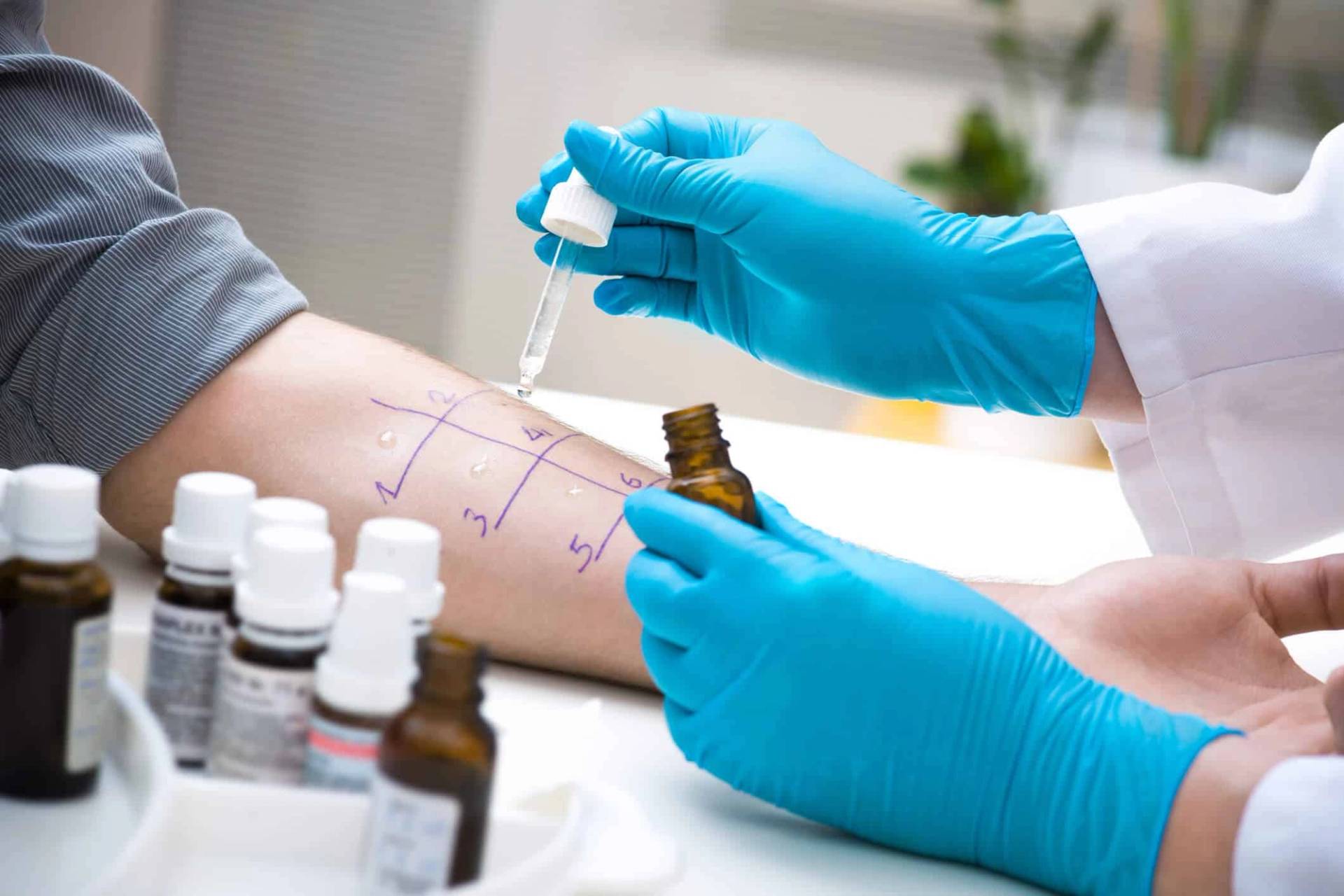 Test allergologique cutané sur un avant-bras.