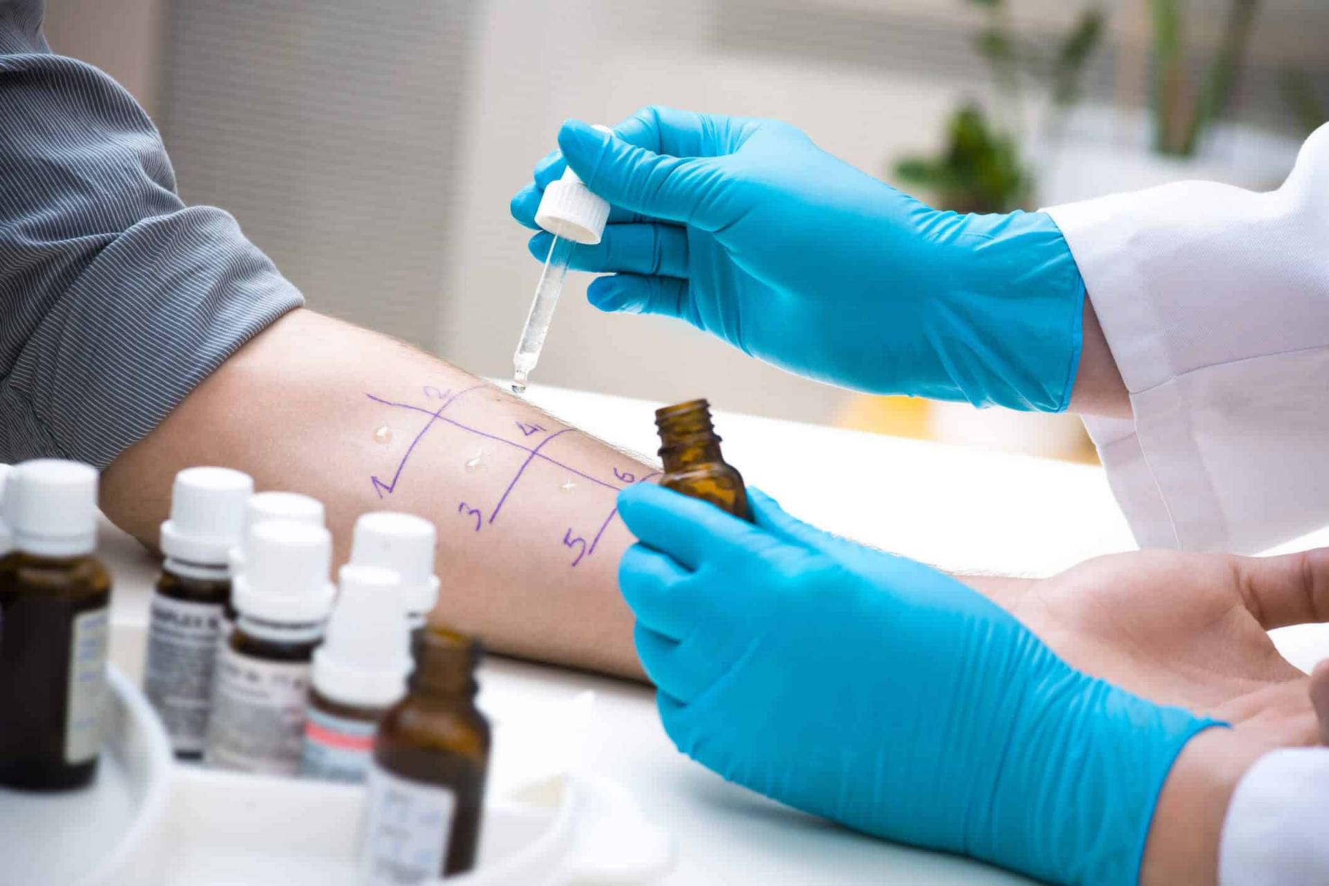 Test allergologique cutané sur un avant-bras.