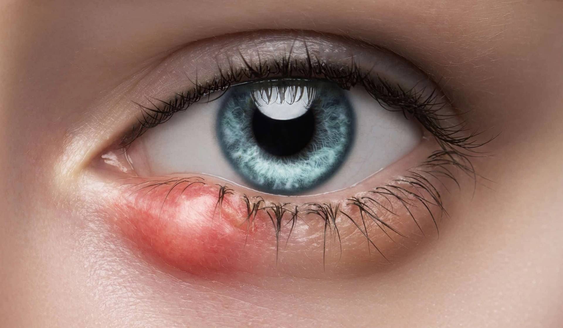 Gros plan sur un œil et une tuméfaction rouge de la paupière inférieure.