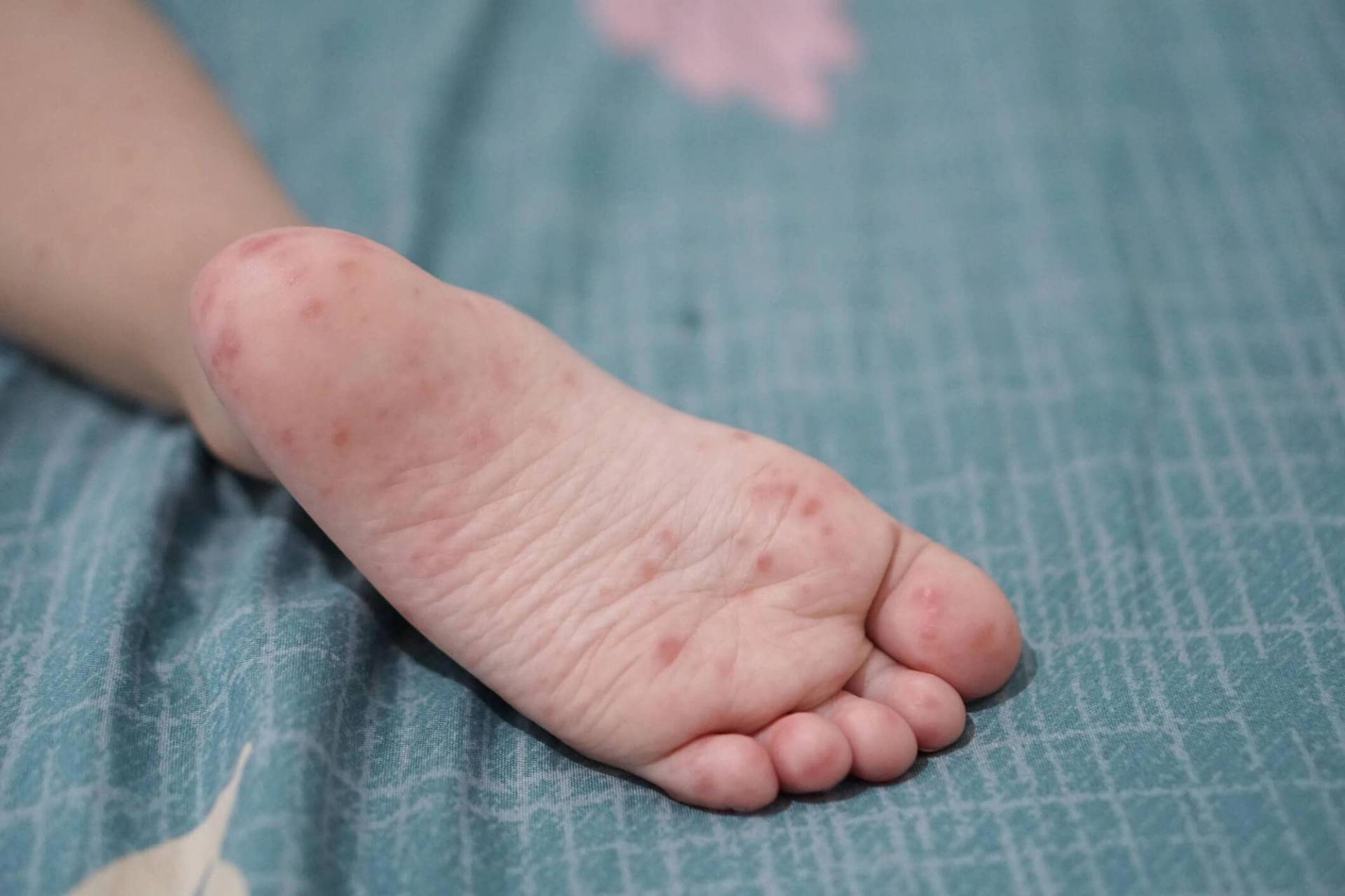 Plante d’un pied d’enfant portant plusieurs petites lésions rouges.