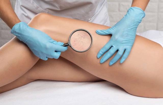 Médecin examinant les jambes d'une patiente pour évaluer un traitement des varices