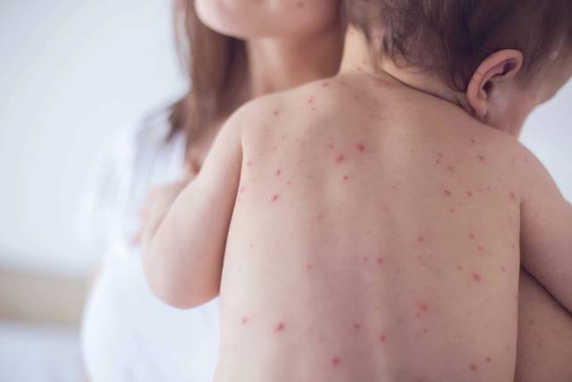 Bébé dans les bras d’un adulte, avec plusieurs lésions rouges visibles sur le dos.