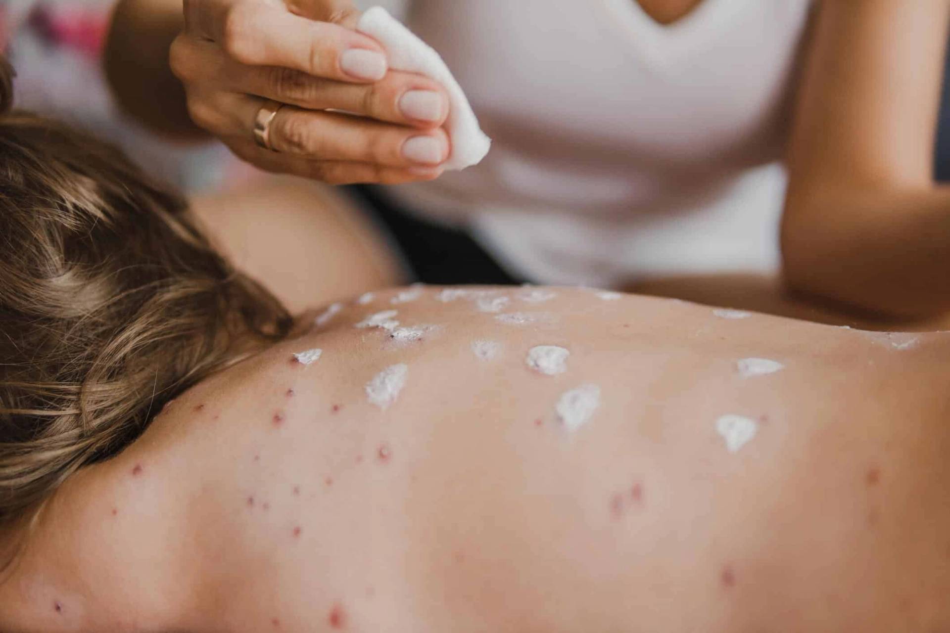 Application d’un produit blanc sur plusieurs lésions rouges du dos d’un enfant.