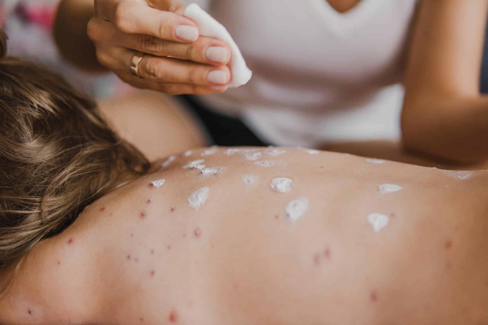 Application d’un produit blanc sur plusieurs lésions rouges du dos d’un enfant.