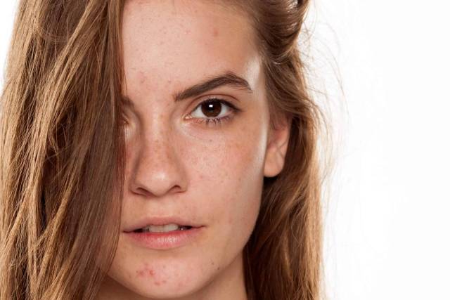 Portrait rapproché d’une femme avec des boutons visibles sur le visage.