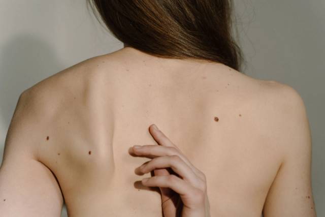 Dos présentant plusieurs grains de beauté, avec une main posée entre les épaules.