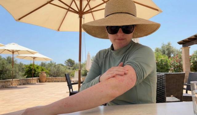 Personne portant un chapeau, se frottant un avant-bras rougi sous un parasol.