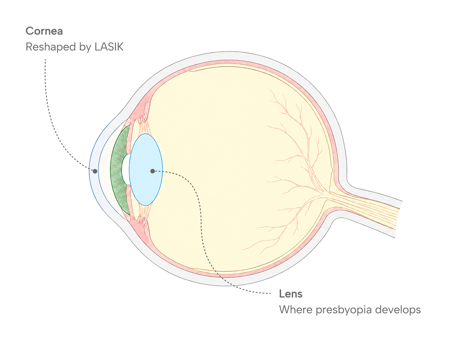 Cross-section diagram of the eye showing the cornea, which LASIK reshapes, and the lens, where age-related presbyopia develops.