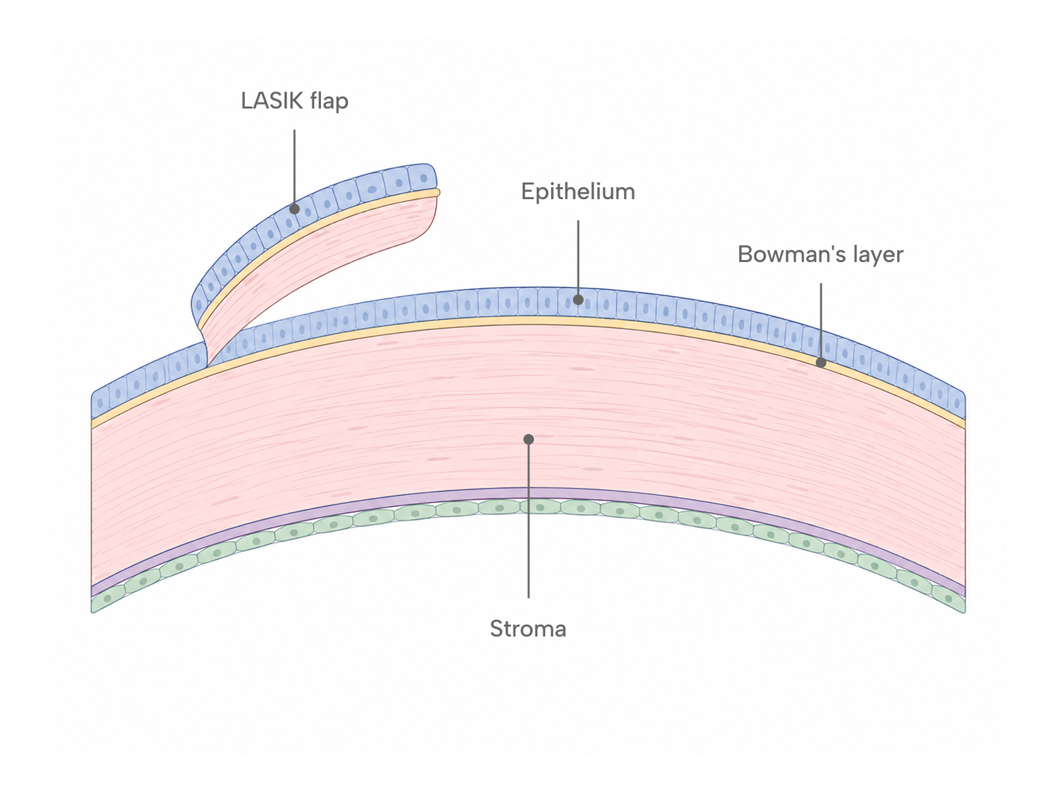 Cross-section diagram of the cornea showing the epithelium, Bowman's layer, and stroma, with the LASIK flap lifted from the outer layers.