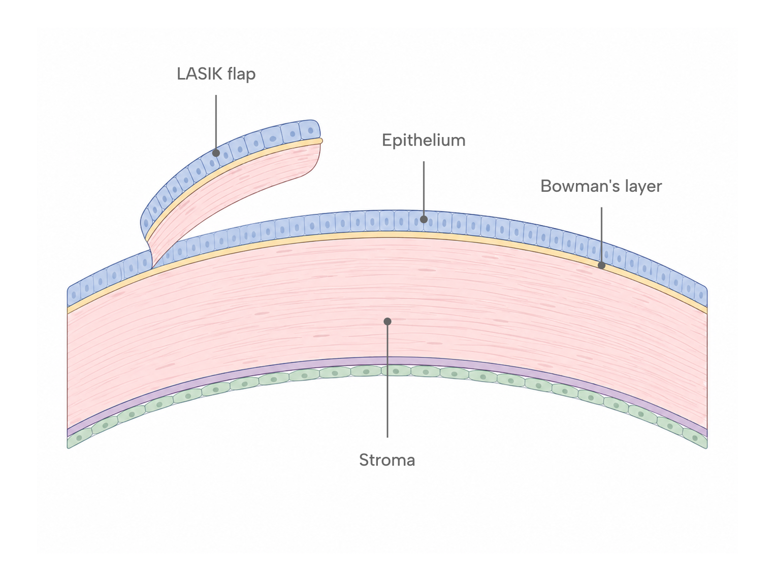 Cross-section diagram of the cornea showing the epithelium, Bowman's layer, and stroma, with the LASIK flap lifted from the outer layers.