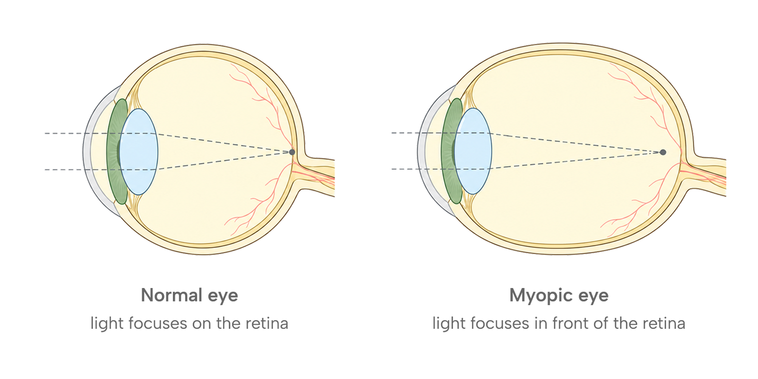 Two side-by-side cross-section diagrams of an eyeball. In the left eye, dashed light rays converge at a point on the back wall. The right eye is longer from front to back, and the rays converge just in front of the back wall. Captions read "Normal eye" and "Myopic eye".