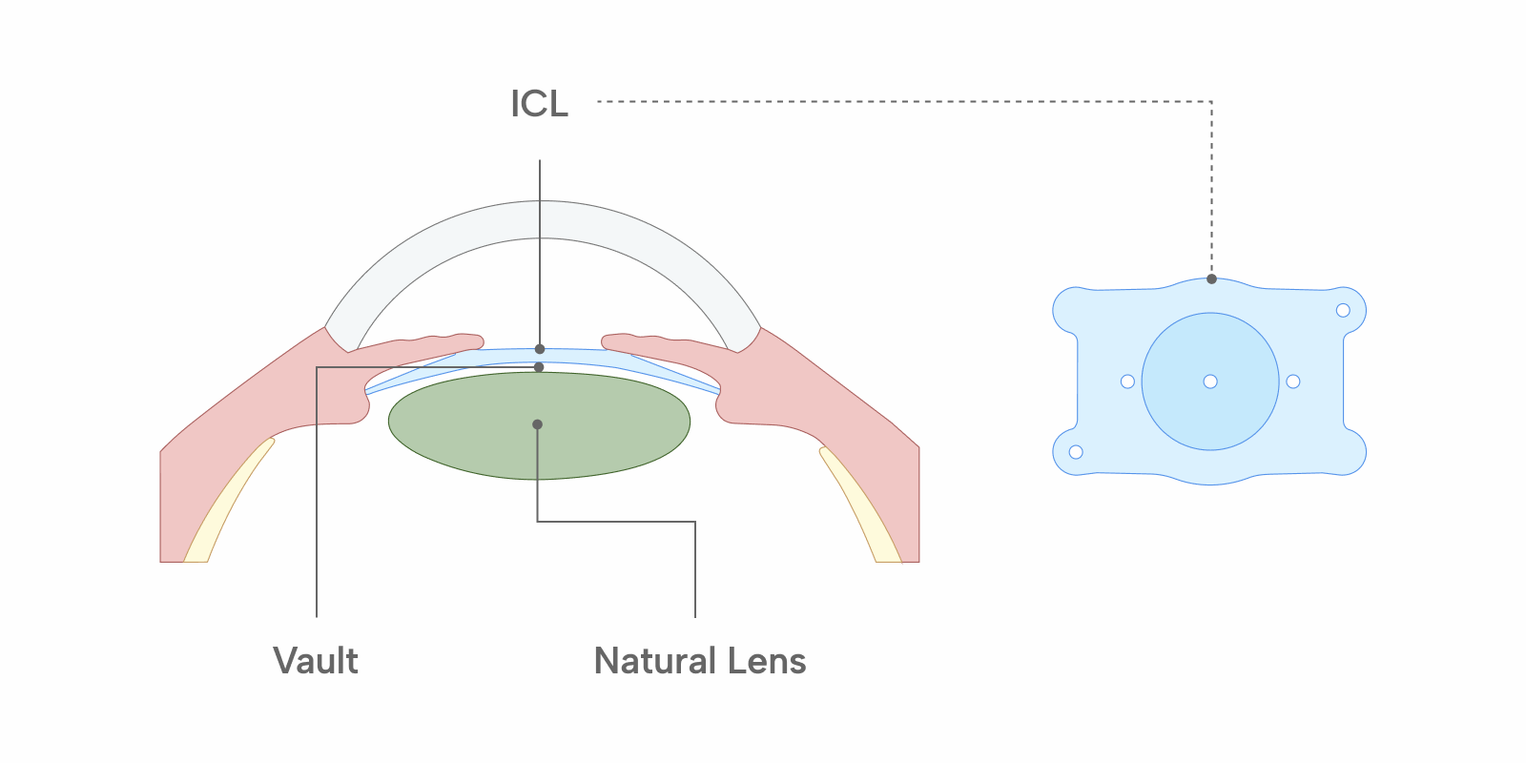 Cross-section of the eye showing an ICL positioned behind the iris and in front of the natural lens, with the vault between them, alongside a front view of the lens.
