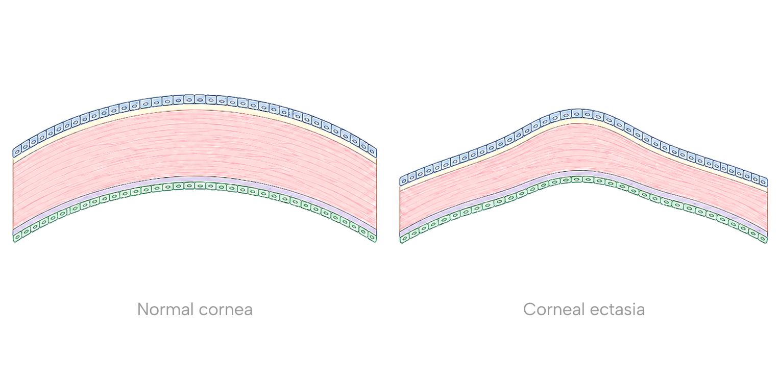 Side-by-side cross-section diagram comparing a normal cornea with a cornea affected by ectasia, where the tissue has thinned and bulged forward.