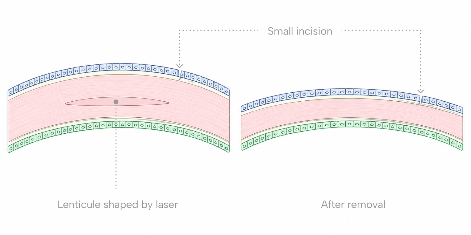 Side-by-side cross-section diagram showing a lenticule shaped inside the cornea and the flattened corneal curvature after it is removed through a small incision.